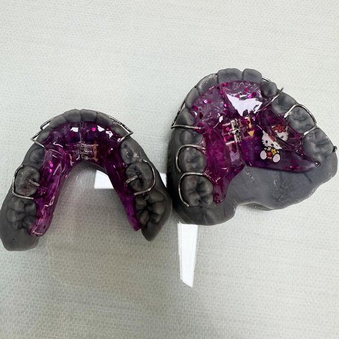 Dois aparelhos ortodônticos removíveis com expansor, sobre modelos de gesso